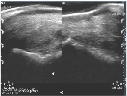 tendon-and-ligaments-2 Tendon and ligament xray images