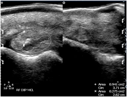 tendon-and-ligaments Tendon and ligament xray images